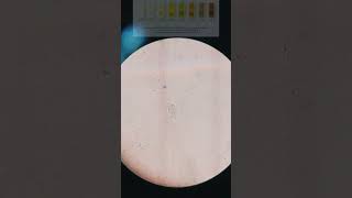 🎥Trichomoniasis Trichomonas in urine under 🎥📲Microscope Its Symptoms and sign With treatment [upl. by Mafala545]