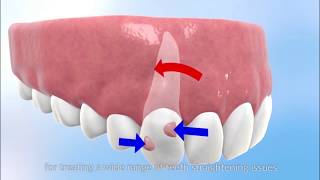 HOW WILL INVISALIGN STRAIGHTEN YOUR TEETH [upl. by Yankee]