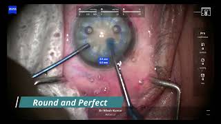 Capsular Ironing to Prevent Runoff Capsulorhexis and Argentinian Flag Sign in Intumescent Cataract [upl. by Adriana300]