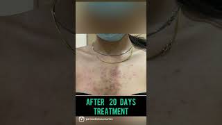 Best Back Acne Treatment in Punjab  Is Back Acne curable Dr Ashima Goel PARISA skin clinic [upl. by Tull]