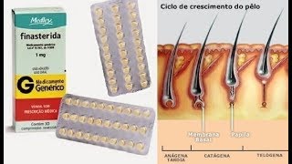 TRICOLOGIA CAPILAR  Finasterida funciona acabe de vez com a Queda de Cabelo por Rafael Secolin [upl. by Zeuqcaj]