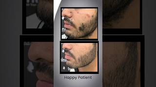 Mole removal treatment at skinaa clinic for a perfect even tone skin viral shorts skincare [upl. by Revart]