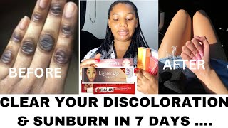 MY TOP 4 WHITENING GEL TUBE FOR DISCOLORATION amp SUNBURN Visible result in 7 daysviralvideo [upl. by Slavin]