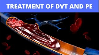 Treatment of DVT and PE [upl. by Saberio]