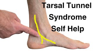 7 Tips for Treating Tarsal Tunnel Syndrome [upl. by Yorel721]