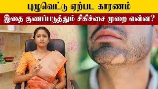 Treatment for Alopecia Areata Tamil  புழுவெட்டு வளர்வதை தடுப்பது எப்படி [upl. by Anon]