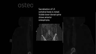 Sacralization of L5 vertebral body is noted spinesurgeon neurosurgeon orthopedicsurgeon [upl. by Franciska]