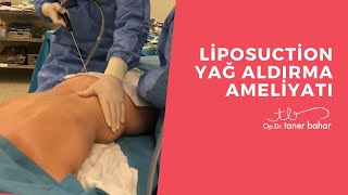 Liposakşın  Liposuction Yağ Aldırma Ameliyatı  OpDrTaner Bahar [upl. by Cecil]