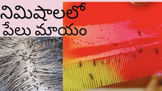 ఇలా చేస్తే నిమిషాలలో మీ తలలో పేలతో పాటుఈపులు కూడ మాయంజన్మలో పేలు పట్టవుHome remedies for Liceampnits [upl. by Iteerp]