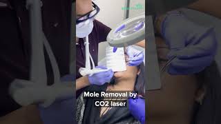 Mole Removal by CO2 Laser [upl. by Wimsatt]