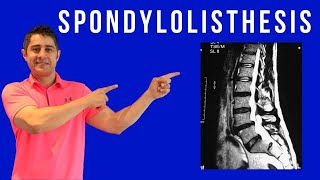 Spondylolisthesis Cause Symptoms and treatment for pain relief [upl. by Amhsirak185]