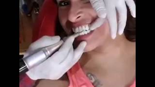 Smile MakeoverHow to Veneers process [upl. by Derwon]