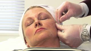 Facial rejuvenation with dermal fillers [upl. by Animsaj]