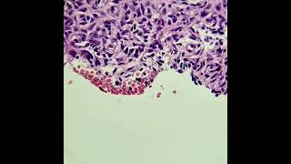 Dermatofibroma aneurismático e com hemossiderina [upl. by Anaeel758]