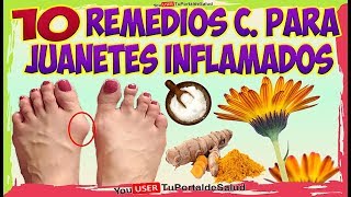 COMO ELIMINAR LOS JUANETES con Estos 10 Remedios Caseros Para los JUANETES INFLAMADOS [upl. by Daney125]