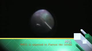 Surgical Management of Macular Folds Secondary to Severe Ocular Hypotony by Alejandro Lopez Gaona M [upl. by Elbys]