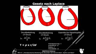 WINFOCUS Webinar  Aortenstenose AS und linksventrikuläre Ausflusstrakt Obstruktion LVOTO [upl. by Maribel147]