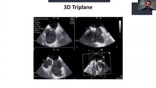 Evaluation of atrial septal defects and guidance for transcatheter closure [upl. by Hanala]