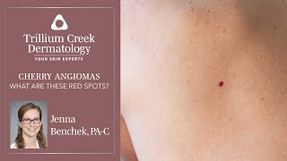 What are Cherry Angiomas [upl. by Kcirderfla920]