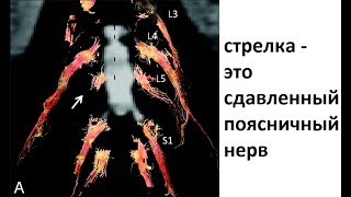 Каким образом грыжа диска сдавливает корешки и воспаляется [upl. by Retseh]