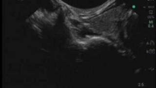 UltrasoundGuided Stellate Ganglion Block [upl. by Emmey]