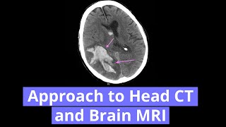 Approach to Head CT and Brain MRI [upl. by Trellas998]