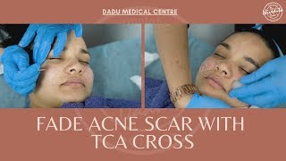 TCA CROSS for acne scarring  TCA Cross treatment for ACNE SCARS [upl. by Reinhart63]