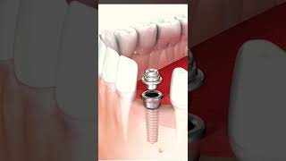 Dental Implant Front Tooth  Tooth Implant shorts viralvideo [upl. by Alla825]