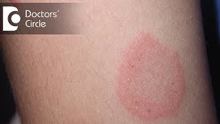 How to manage Chronic Ringworm infection  Dr Rajdeep Mysore [upl. by Gord]