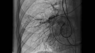 Pulmonary embolism Part 3 [upl. by Atsocal]