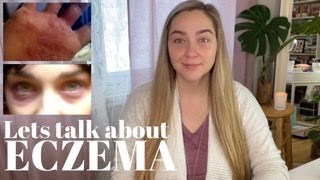 What is eczema [upl. by Ahsytal]