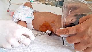 Drainage of MASSIVE Chylothorax in Infant Lung  Medical procedure [upl. by Putnam]