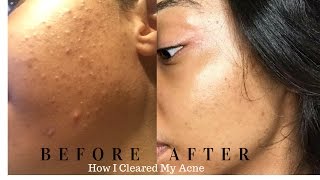 Acne Series Part 13 How I Cleared My Acne Using Acneorg  Crystal Monique [upl. by Melda]