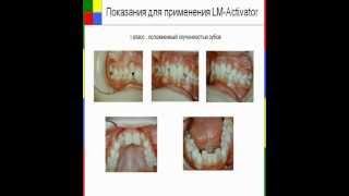 Клиническое применение LMActivator [upl. by Abdulla]