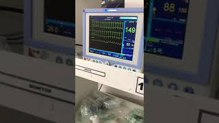 Taquicardia Sinusal em monitorização  Sinus tachycardia under monitoring [upl. by Ruosnam]