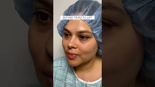 Before amp After Trifecta Lift  Latina Patient  Dr Kami Parsa Beverly Hills [upl. by Anelrac]