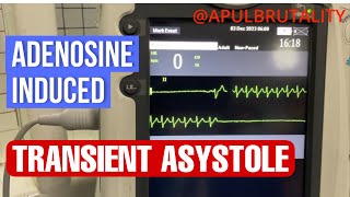 Adenosineinduced transient asystole during SVT treatment [upl. by Ahsikahs]