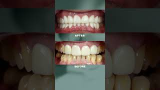 Transform Your Smile with Zirconium Crowns  Dental Crowns Before amp After [upl. by Haskell]