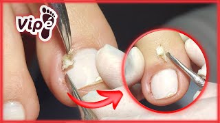 PODOLOGIA EM UNHA ENCRAVADA OVERGROWN INFECTED INGROWN TOENAIL REMOVAL [upl. by Denzil]