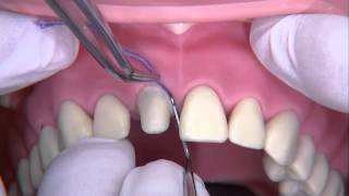 Gingivale Retraktion und definitive Abformung [upl. by Sauls]