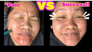 Dermapen Microneedling  What How amp Why  Tagalog [upl. by Kurman]