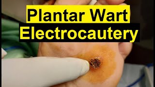 Treatment of Viral Warts  Electrocautery Procedure [upl. by Gerrald313]